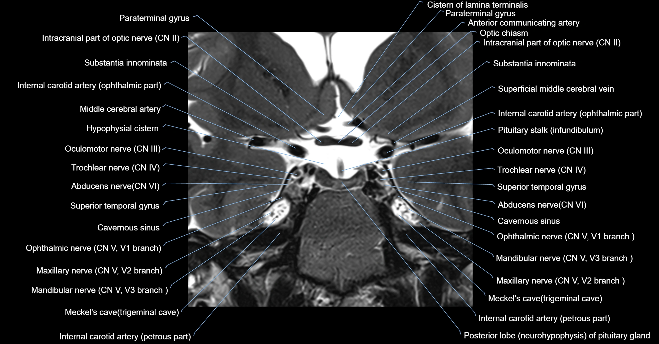 MRI cavernous sinus coronal cross sectional 3T anatomy image-img-00001-00012.webp
